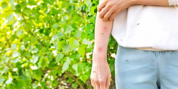 Someone Standing in the Yard Scratching at Mosquito Bites